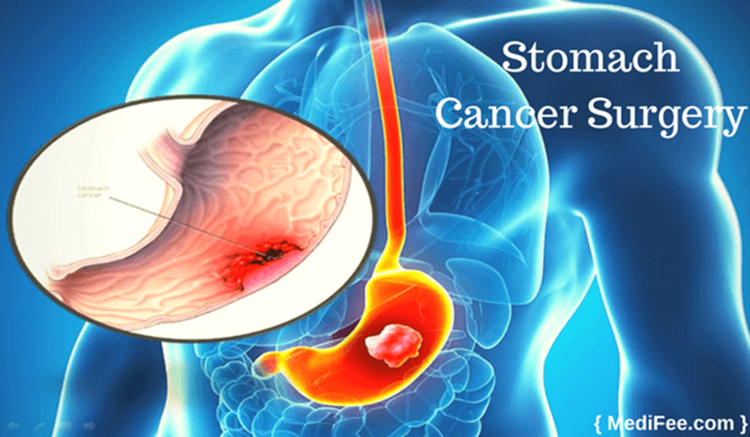 GI Cancer Surgery Image