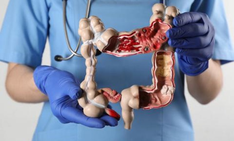 Colorectal Cancer Surgery Image