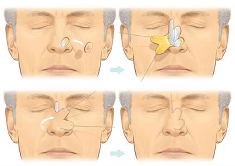 Head and Neck Cancer Surgery with Reconstruction Image
