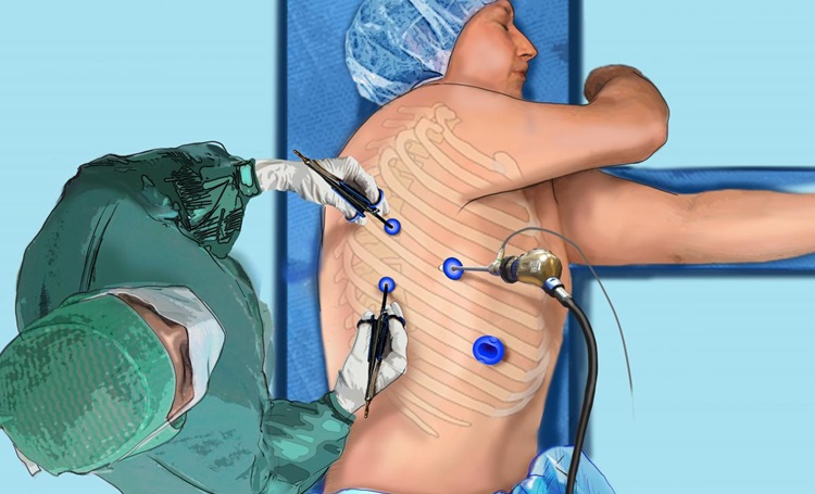 Thoracic Cancer Surgery Image